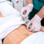 Jak działa lipoliza i czy warto poddać się temu zabiegowi?